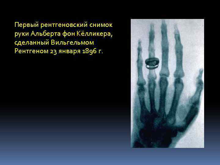 Первый рентгеновский снимок руки Альберта фон Кёлликера, сделанный Вильгельмом Рентгеном 23 января 1896 г.