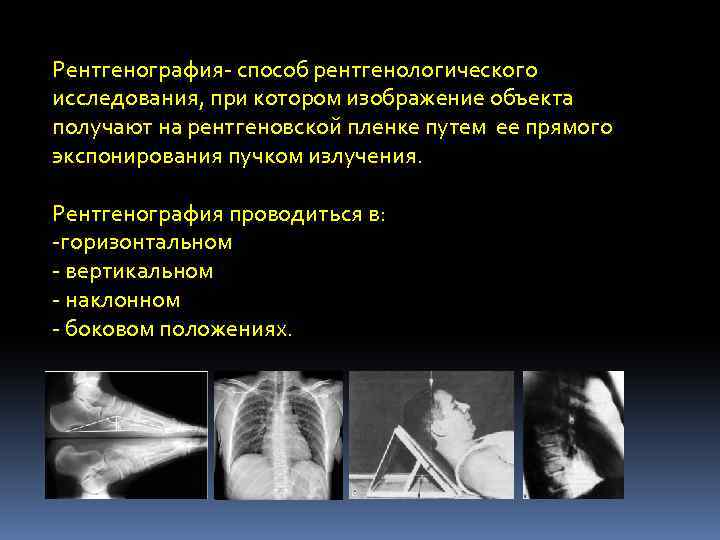 Рентгенография- способ рентгенологического исследования, при котором изображение объекта получают на рентгеновской пленке путем ее