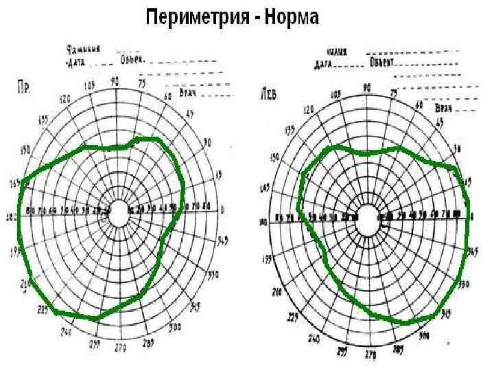 Периметрия расшифровка. Периметрия поля зрения норма. Периметрия отслойка сетчатки. Поля зрения при отслойке сетчатки. Компьютерная периметрия скотома.