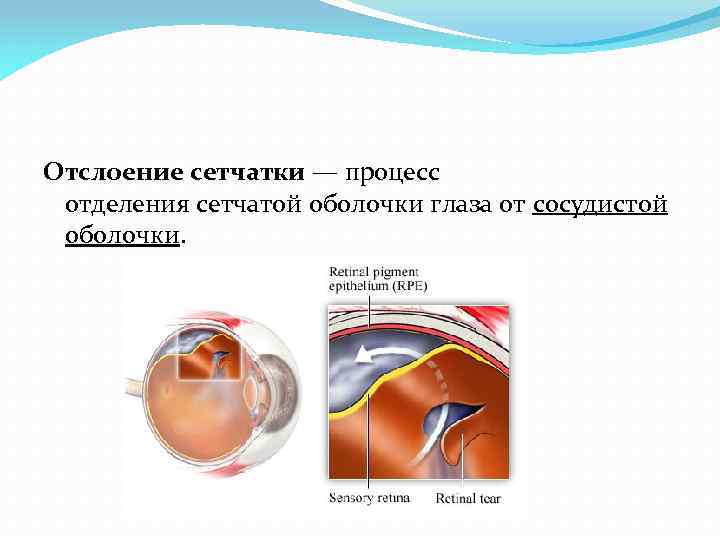 Отслоение сетчатки — процесс отделения сетчатой оболочки глаза от сосудистой оболочки. 