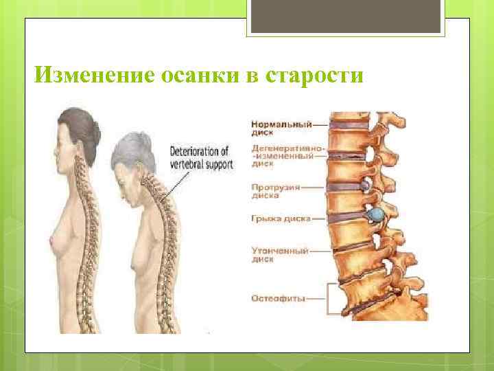 Изменение осанки в старости 