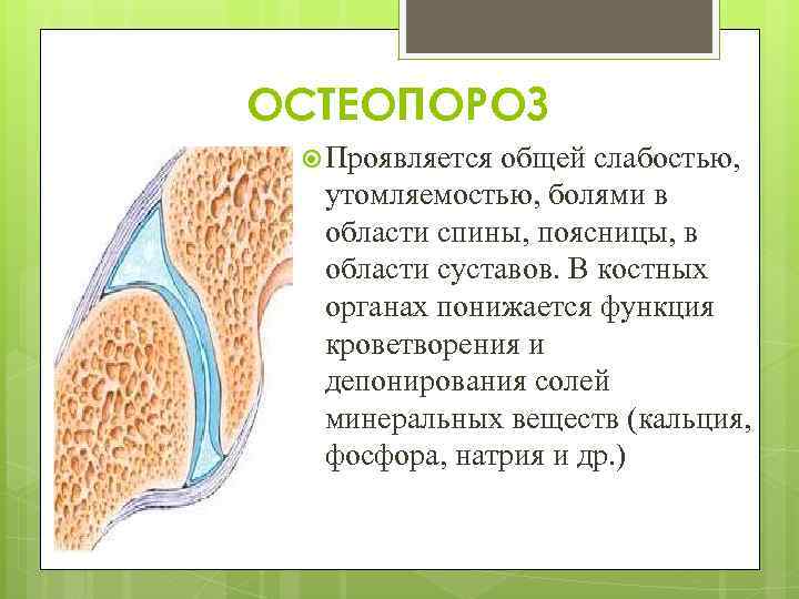 ОСТЕОПОРОЗ Проявляется общей слабостью, утомляемостью, болями в области спины, поясницы, в области суставов. В