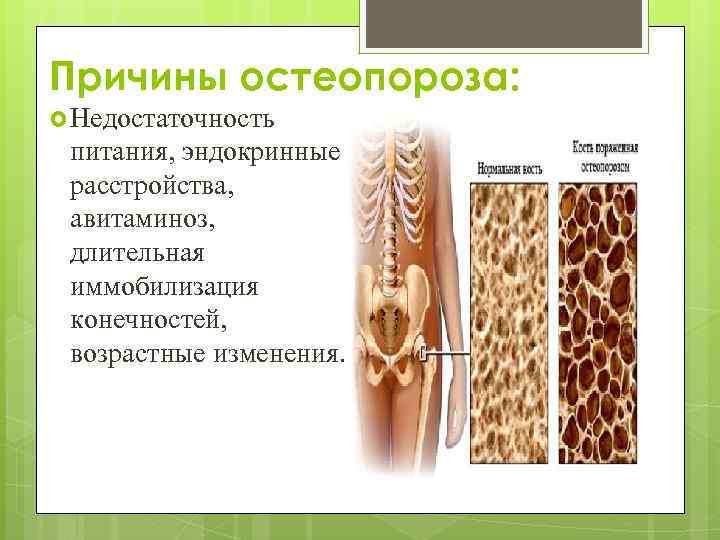 Причины остеопороза: Недостаточность питания, эндокринные расстройства, авитаминоз, длительная иммобилизация конечностей, возрастные изменения. 