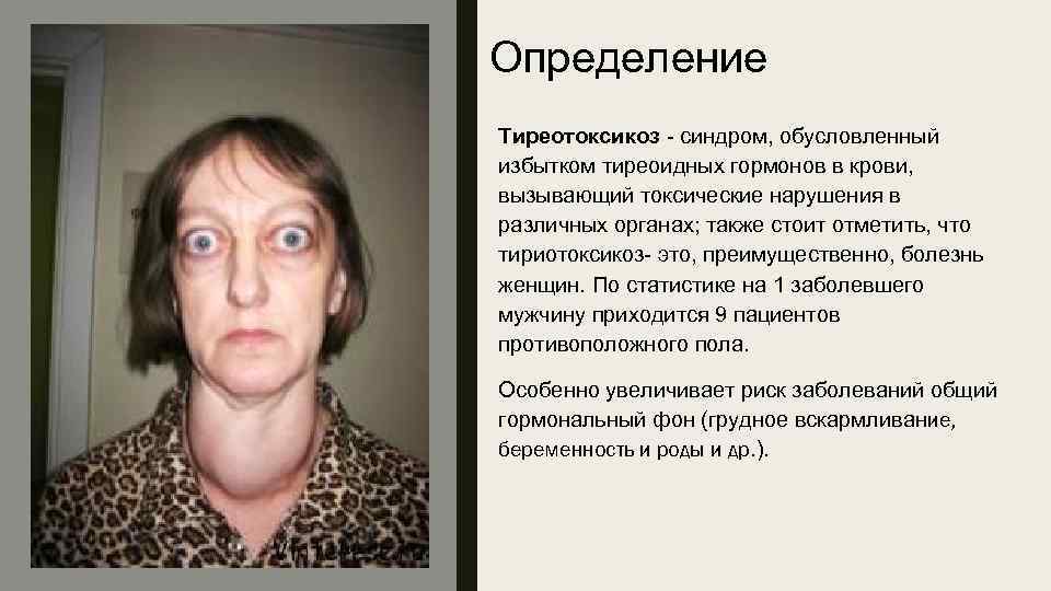 Определение Тиреотоксикоз - синдром, обусловленный избытком тиреоидных гормонов в крови, вызывающий токсические нарушения в