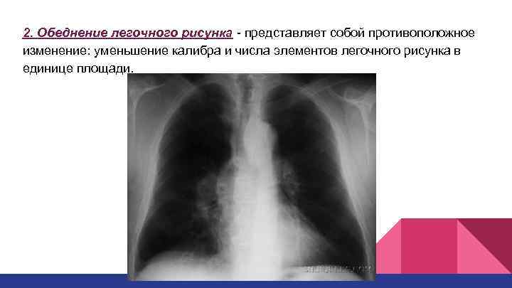 2. Обеднение легочного рисунка - представляет собой противоположное изменение: уменьшение калибра и числа элементов