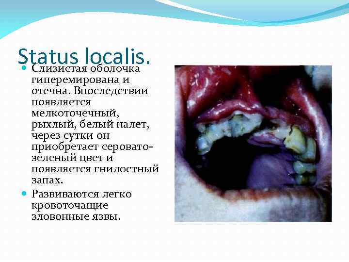 Status localis. Слизистая оболочка гиперемирована и отечна. Впоследствии появляется мелкоточечный, рыхлый, белый налет, через