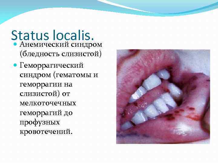 Status localis. Анемический синдром (бледность слизистой) Геморрагический синдром (гематомы и геморрагии на слизистой) от