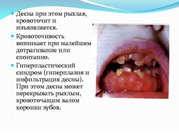  Десна при этом рыхлая, кровоточит и изъязвляется. Кровоточивость возникает при малейшем дотрагивание или