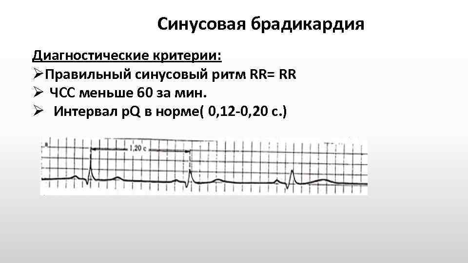 Синусоидная брадикардия. Синусоваябоадикардия ЭКГ. Минусовая браликарлия ЭКГ. Синусовая брадикардия критерии ЭКГ.