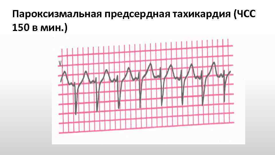 Пароксизмальная предсердная тахикардия (ЧСС 150 в мин. ) 