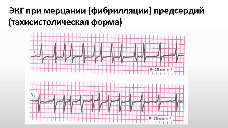 Фибрилляции предсердий карта вызова