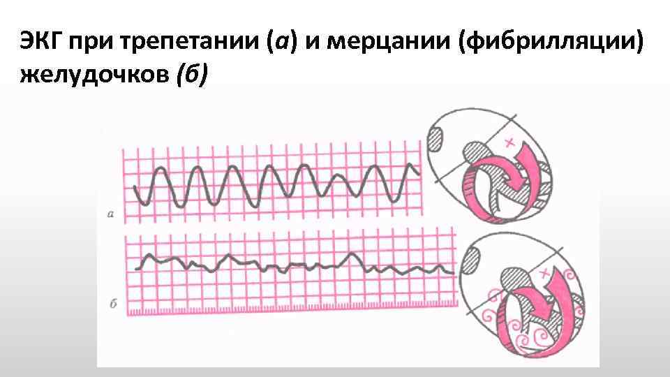 ЭКГ при трепетании (а) и мерцании (фибрилляции) желудочков (б) 