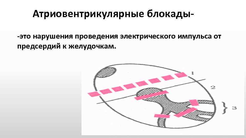 Атриовентрикулярные блокады это нарушения проведения электрического импульса от предсердий к желудочкам. 