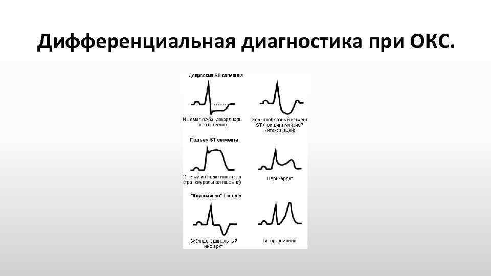 Дифференциальная диагностика при ОКС. 