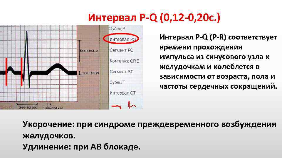 Интервал P Q (0, 12 0, 20 с. ) Интервал P Q (P R)