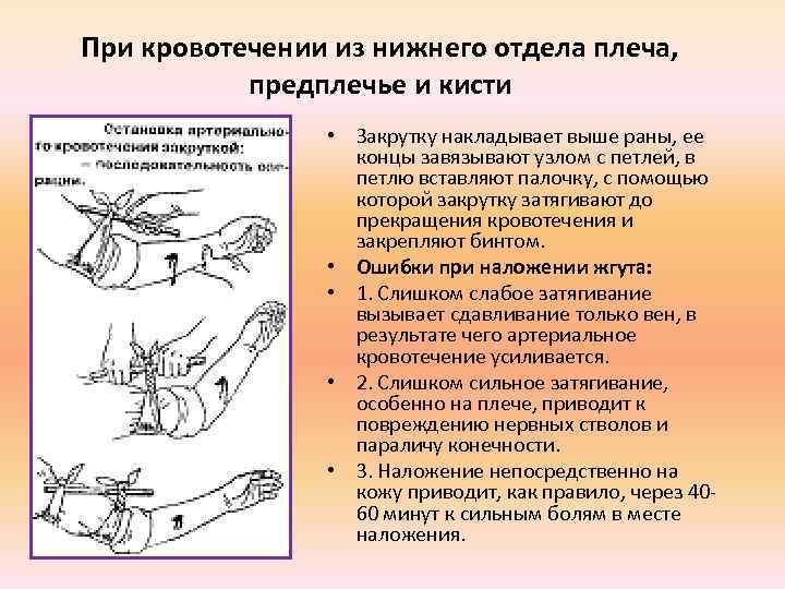 При кровотечении из нижнего отдела плеча, предплечье и кисти • Закрутку накладывает выше раны,