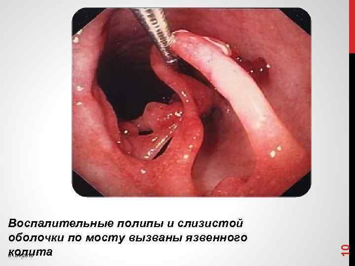 10 Воспалительные полипы и слизистой оболочки по мосту вызваны язвенного колита 01. 04. 2015