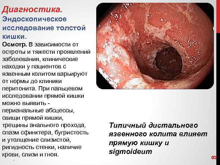 Диагностика. Осмотр. В зависимости от остроты и тяжести проявлений заболевания, клинические находки у пациентов