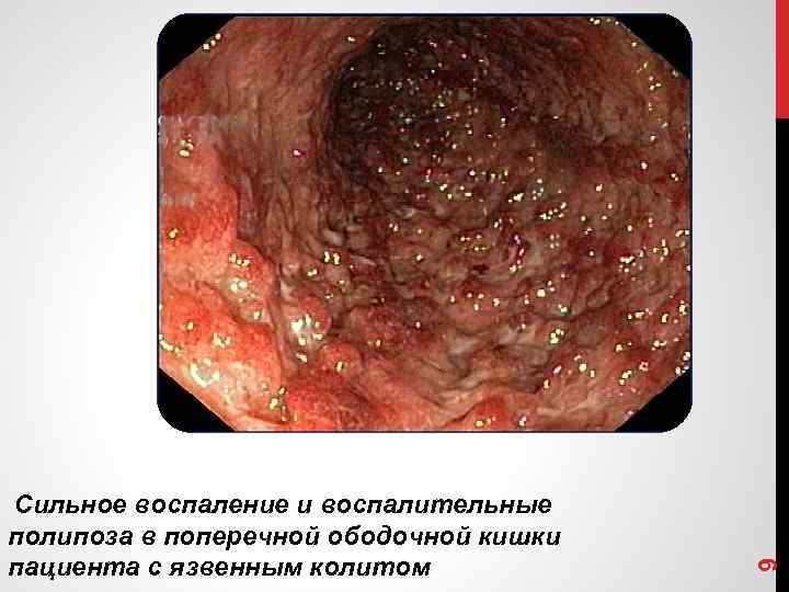 9 Сильное воспаление и воспалительные полипоза в поперечной ободочной кишки , пациента с язвенным