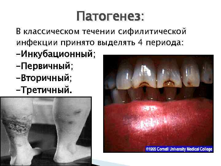 Патогенез: В классическом течении сифилитической инфекции принято выделять 4 периода: -Инкубационный; -Первичный; -Вторичный; -Третичный.