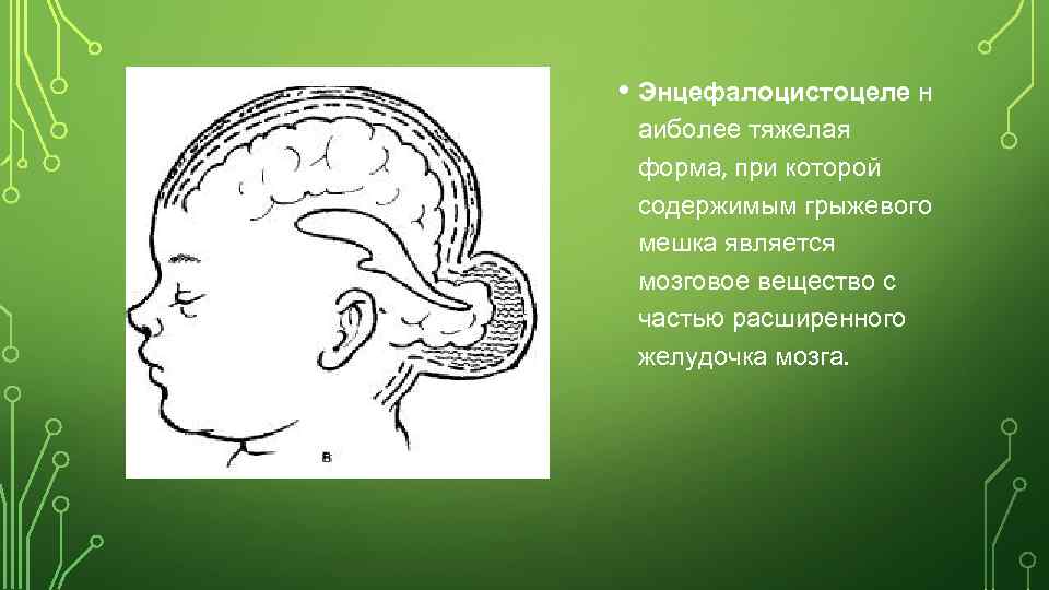 • Энцефалоцистоцеле н аиболее тяжелая форма, при которой содержимым грыжевого мешка является мозговое