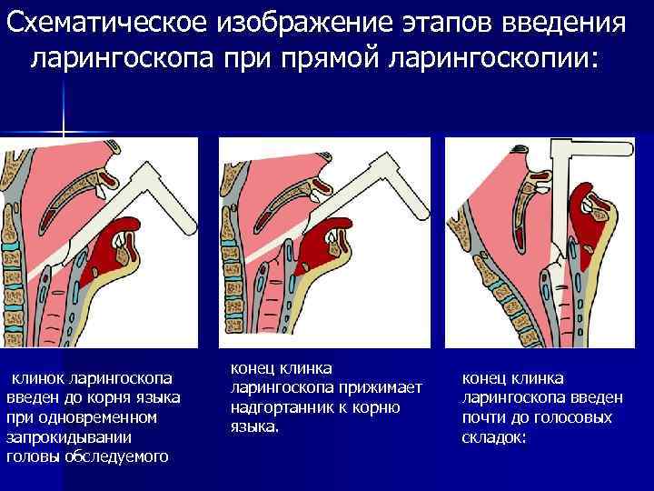 Схематическое изображение этапов введения ларингоскопа при прямой ларингоскопии: n клинок ларингоскопа введен до корня