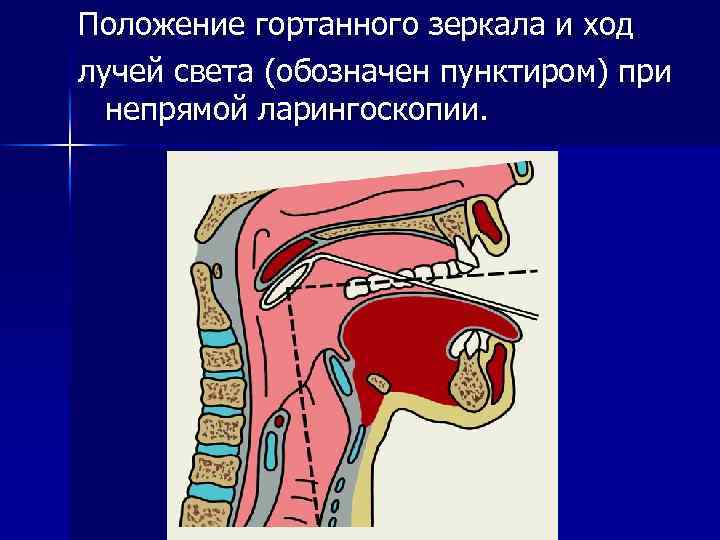 Положение гортанного зеркала и ход лучей света (обозначен пунктиром) при непрямой ларингоскопии. 