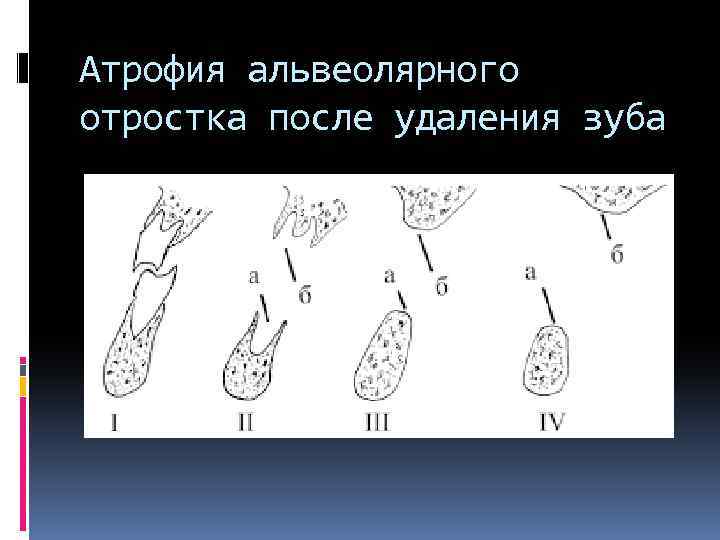 Атрофия альвеолярного отростка после удаления зуба 