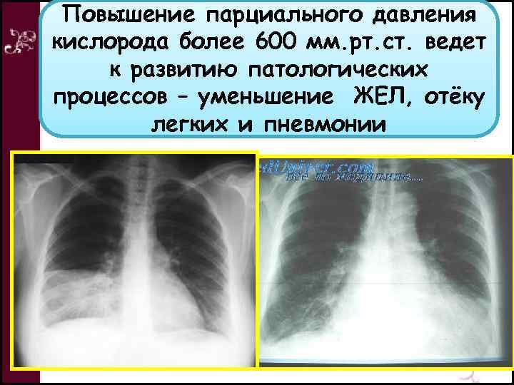 Повышение парциального давления кислорода более 600 мм. рт. ст. ведет к развитию патологических процессов