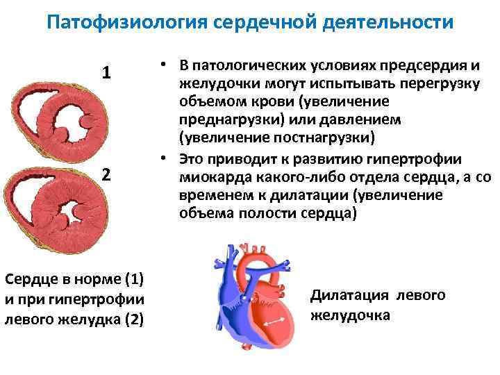 Патофизиология сердечной деятельности 1 2 Сердце в норме (1) и при гипертрофии левого желудка