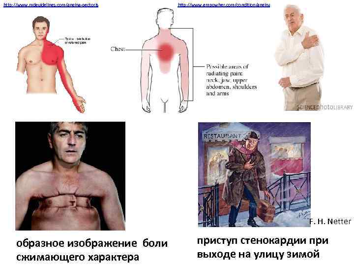 http: //www. mdguidelines. com/angina-pectoris http: //www. empowher. com/condition/angina F. H. Netter образное изображение боли