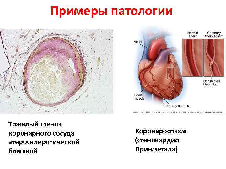 Примеры патологии Тяжелый стеноз коронарного сосуда атеросклеротической бляшкой Коронароспазм (стенокардия Принметала) 