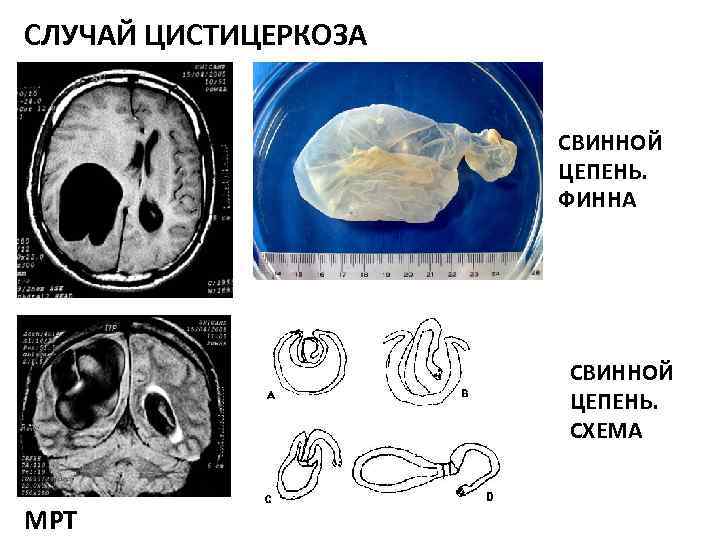 СЛУЧАЙ ЦИСТИЦЕРКОЗА СВИННОЙ ЦЕПЕНЬ. ФИННА СВИННОЙ ЦЕПЕНЬ. СХЕМА МРТ 