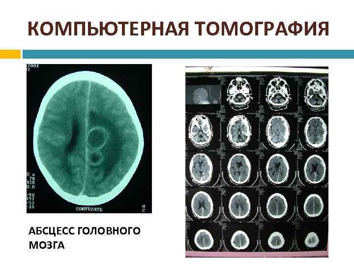 КОМПЬЮТЕРНАЯ ТОМОГРАФИЯ АБСЦЕСС ГОЛОВНОГО МОЗГА 