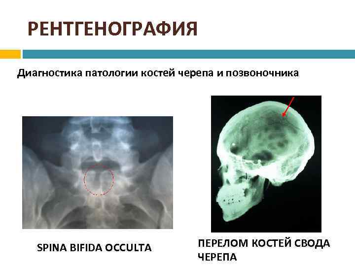 РЕНТГЕНОГРАФИЯ Диагностика патологии костей черепа и позвоночника SPINA BIFIDA OCCULTA ПЕРЕЛОМ КОСТЕЙ СВОДА ЧЕРЕПА