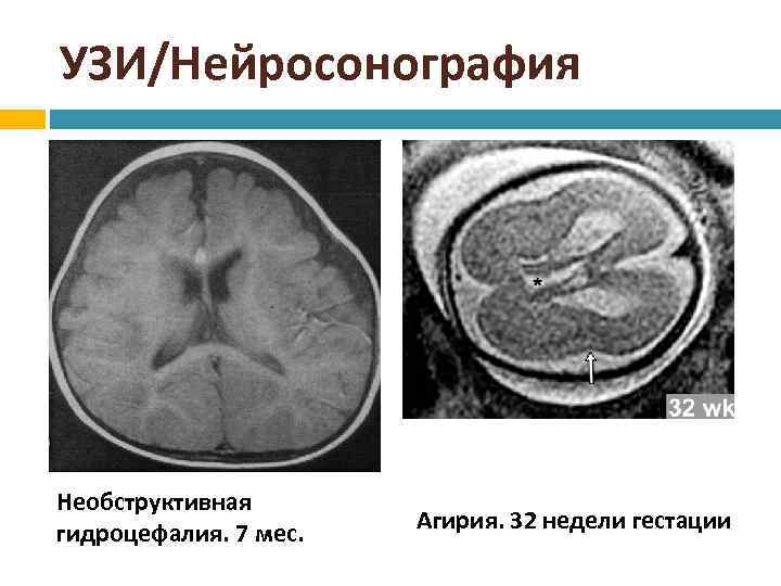 УЗИ/Нейросонография Необструктивная гидроцефалия. 7 мес. Агирия. 32 недели гестации 