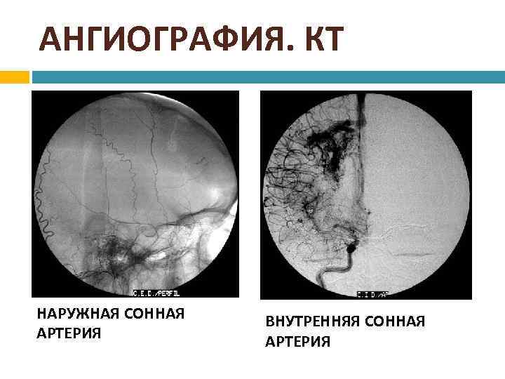 АНГИОГРАФИЯ. КТ НАРУЖНАЯ СОННАЯ АРТЕРИЯ ВНУТРЕННЯЯ СОННАЯ АРТЕРИЯ 