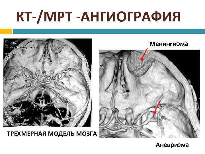 КТ-/МРТ -АНГИОГРАФИЯ Менингиома ТРЕХМЕРНАЯ МОДЕЛЬ МОЗГА Аневризма 