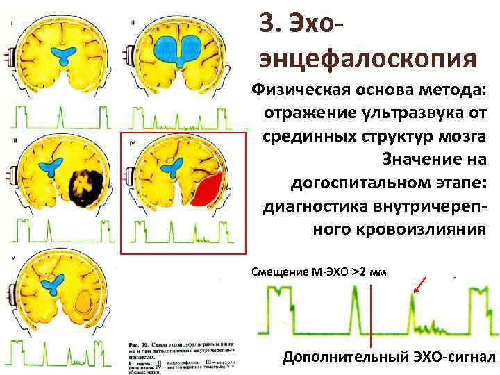 3. Эхоэнцефалоскопия Физическая основа метода: отражение ультразвука от срединных структур мозга Значение на догоспитальном