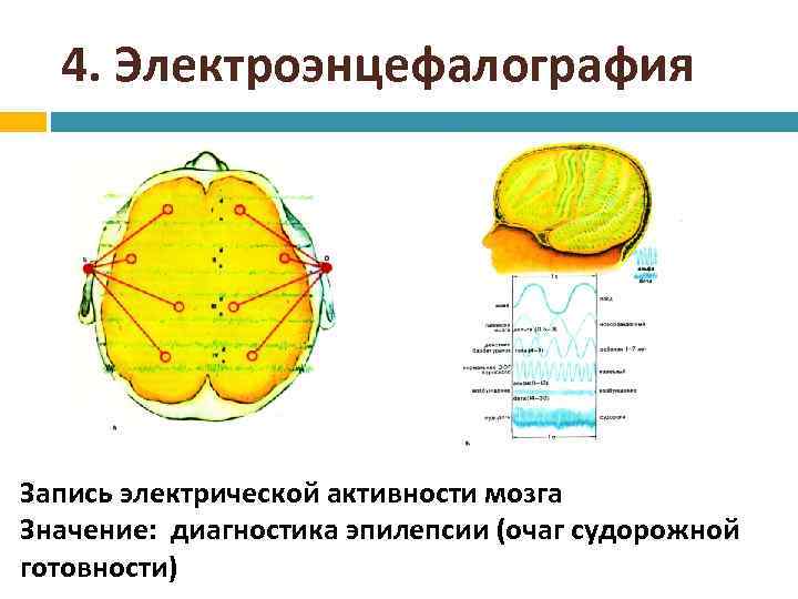 4. Электроэнцефалография Запись электрической активности мозга Значение: диагностика эпилепсии (очаг судорожной готовности) 