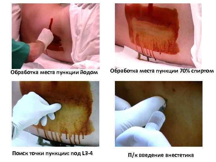 Обработка места пункции йодом Обработка места пункции 70% спиртом Поиск точки пункции: под L