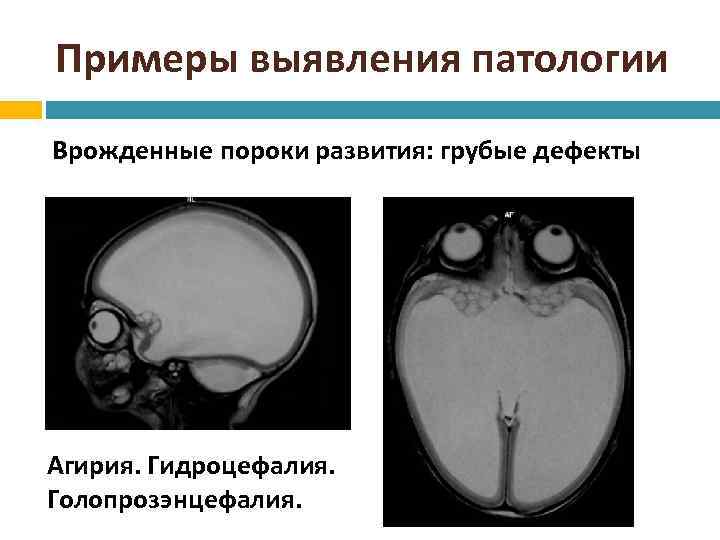 Примеры выявления патологии Врожденные пороки развития: грубые дефекты Агирия. Гидроцефалия. Голопрозэнцефалия. 