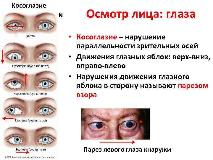 Какой глаз левый а какой правый. Движение глазных яблок. Болезни глаз косоглазие. Нарушение движения глазных яблок. Косоглазие зрение.