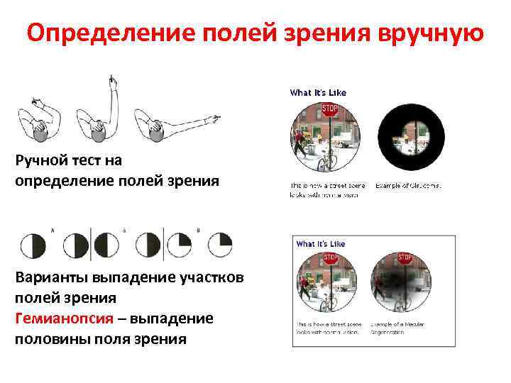 Определение полей зрения вручную Ручной тест на определение полей зрения Варианты выпадение участков полей