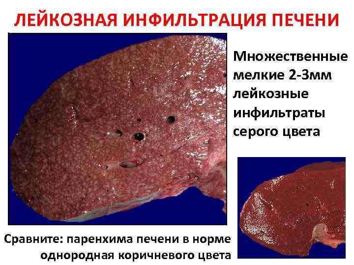 ЛЕЙКОЗНАЯ ИНФИЛЬТРАЦИЯ ПЕЧЕНИ Множественные мелкие 2 -3 мм лейкозные инфильтраты серого цвета Сравните: паренхима