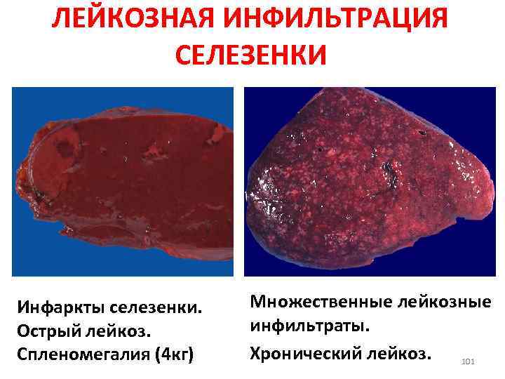 ЛЕЙКОЗНАЯ ИНФИЛЬТРАЦИЯ СЕЛЕЗЕНКИ Инфаркты селезенки. Острый лейкоз. Спленомегалия (4 кг) Множественные лейкозные инфильтраты. Хронический