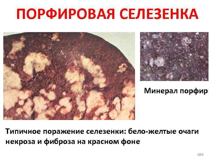 ПОРФИРОВАЯ СЕЛЕЗЕНКА Минерал порфир Типичное поражение селезенки: бело-желтые очаги некроза и фиброза на красном