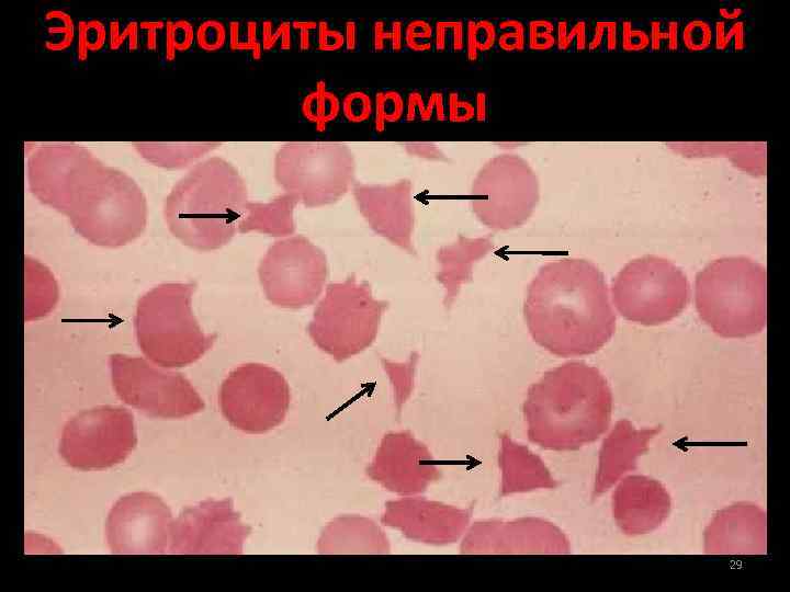 Морфологические изменения в эритроцитах рисунок