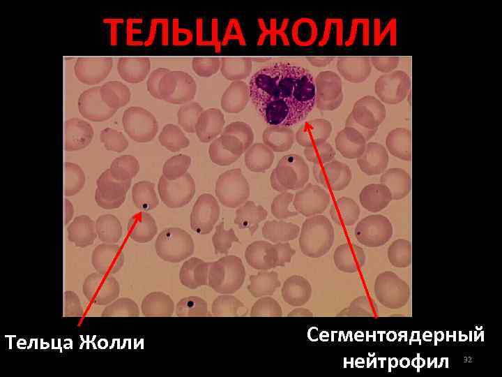 Базофильная пунктация эритроцитов фото