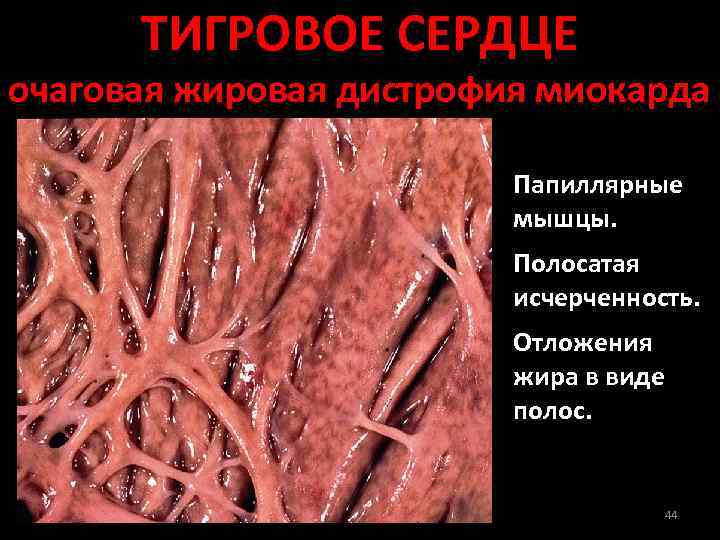 ТИГРОВОЕ СЕРДЦЕ очаговая жировая дистрофия миокарда Папиллярные мышцы. Полосатая исчерченность. Отложения жира в виде